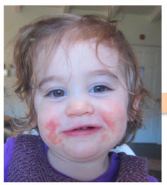 Safe, Natural Treatments and Prevention for Your Child’s Eczema